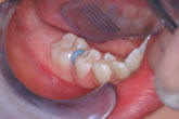 Separator - Orthodontics