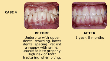 Case 4 before and after dental crowding photo