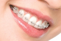 Clear braces