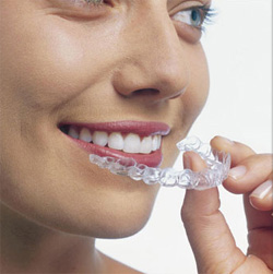 Invisalign