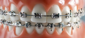 Metal braces